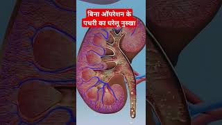 Bina opration pathri ka ilaj ghrelu nuskha stone shortvideos shorts trending healthtips health [upl. by Gilliette862]