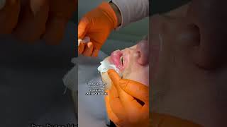 Limpeza em queilite esfoliativa  Cleansing in exfoliative cheilitis [upl. by Reisman]