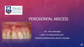 Periodontal Abscess [upl. by Ennahtebazile]