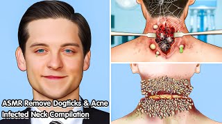 ASMR Deeply Cleansing Neck Infected with Acne and Dogticks [upl. by Llennahc]