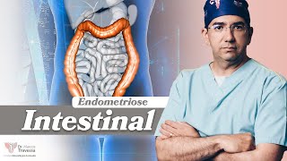 Endometriose Intestinal [upl. by Qerat]