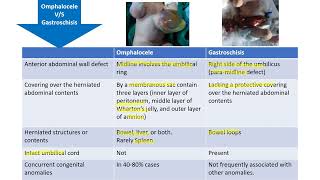 Omphalocele vs Gastroschisis  Spot Diagnosis  6  Pediatrics [upl. by Bardo]