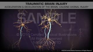 Traumatic Brain Injury [upl. by Reffinej]