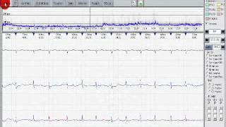 HOLTER MENHIR 1 PARTE [upl. by Elrebma]