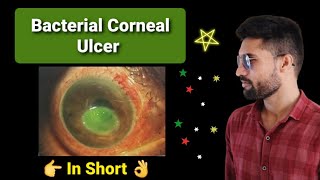 Bacterial corneal ulcer lecture opthalmology [upl. by Lancelle]