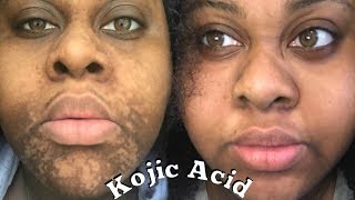 4 MONTHS KOJIC ACID EXPERIENCE \\ Sherelle Saint Rose [upl. by Hgielyk58]