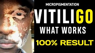 VITILIGO TREATMENTS WHAT WORKS  100  RESULTS [upl. by Frear]