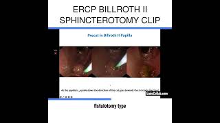 ERCP Billroth II Sphincterotomy Clip [upl. by Burnham]