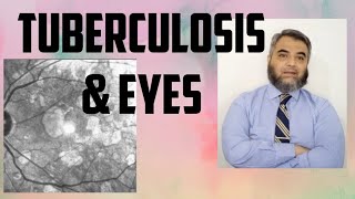 TUBERCULOSIS AND EYES Tuberculosis EyeinfectionRifampicinisoniazidethambutol [upl. by Azeret951]