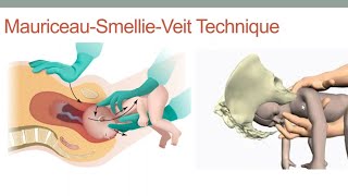 Breech Delivery Maneuvers Obstetrics GYNECOLOGY [upl. by Negem]