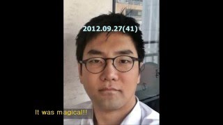 스컬트라 스컬트라효과 스컬트라전후 의사가 직접 체험한 스컬트라 효과 Incredible effect of Sculptra doctors experience [upl. by Yecal]