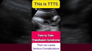 TTTS  Twin to Twin Transfusion Syndrome Ultrasound  Monochorionic TWINS [upl. by Pruter251]