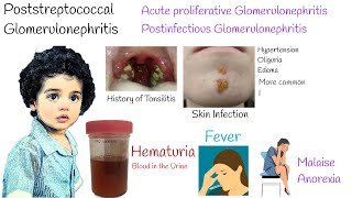 Acute proliferative Glomerulonephritis Poststreptococcal Glomerulonephritis [upl. by Swenson987]