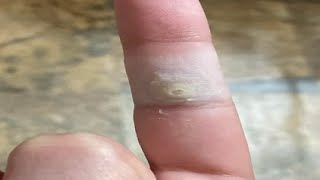 how to get rid of warts on your hand with duct tape [upl. by Worl391]