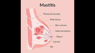 Mastitis Definition of mastitis  Classification of mastitis✨ [upl. by Bradway]