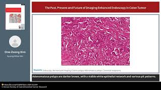 The Past Present and Future of Imaging Enhanced Endoscopy in Colon Tumor [upl. by Fabiano]