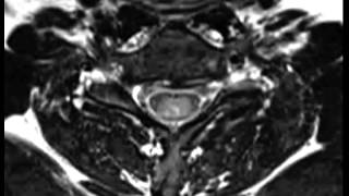 Spinal Ependymoma [upl. by Nosnej]