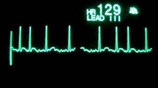 Atrial Fibrillation with RVR [upl. by Irami626]