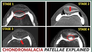 Chondromalacia patellae  The 4 stages and their treatment explained [upl. by Nnylesor751]