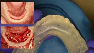 Easy Clinical amp Laboratory Technique for Fabricating an quotInHouse Surgical Guidequot for Overdentures [upl. by Drew703]