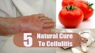 5 Home Remedies for Cellulitis  By Top 5 [upl. by Saenihp547]