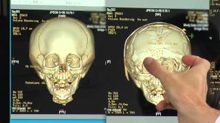 Craniosynostosis Treatment Options for Metopic amp Unilateral Coronal Synostosis  Part 6 of 6 [upl. by Lumpkin388]