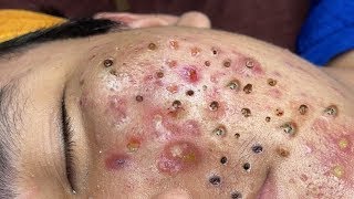 Big Cystic Acne Blackheads Extraction Blackheads amp Milia Whiteheads Removal Pimple Popping  4447 [upl. by Murrell]