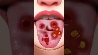 Stomatitis treatment  tongue piercing careasmr youtubeshorts ytshorts asmrshorts [upl. by Inavihs614]