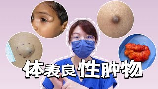 “开盲盒”到底在开什么？——常见体表良性肿物cyst lipoma pimplepopping [upl. by Elirpa]