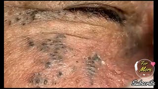 Dr Pop  Deep Blackheads in old Skin removing amp treatment 2020 Part 5 [upl. by Cann384]