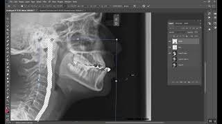 Treatment of Class III malocclusion المرحلة الخامسة [upl. by Brag605]