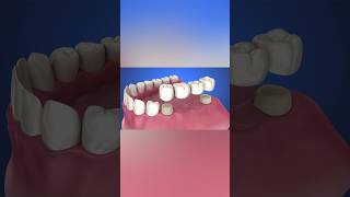 Tooth supported fixed bridge instalation process medicalanimation health dentist [upl. by Etteniotna271]