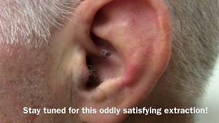 Ear Blackhead Extraction  Dr Steven Greene in Seattle [upl. by Steve565]