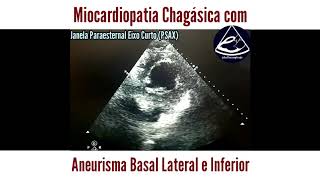 Casos de ECO Aneurisma Basal Inferolateral por Doença de Chagas [upl. by Attenal978]