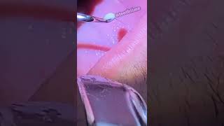 Deep Tonsil Stone Removal  Tonsil Stones  Tooth Time Family Dentistry New Braunfels Texas [upl. by Annalise]