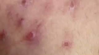 new pimple popping videos blackheads 2023 5 [upl. by Whitby]