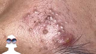 This Week In PIMPLE POPPING 34 [upl. by Eisak]