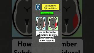 🔥 How to Remember Subdural vs Epidural Hematomas in 60 Seconds Nursing [upl. by Lorelie664]