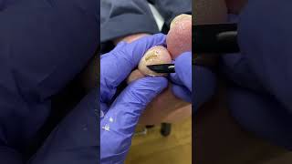 Diabetic Ulcer FollowUp Expert Callus Removal by Australian Podiatrist [upl. by Uela707]