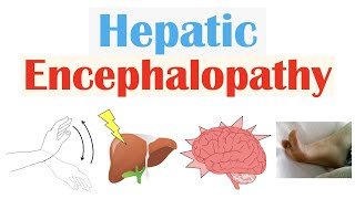 Hepatic Encephalopathy  Pathophysiology Triggers Signs amp Symptoms Diagnosis Treatment [upl. by Oidacra]