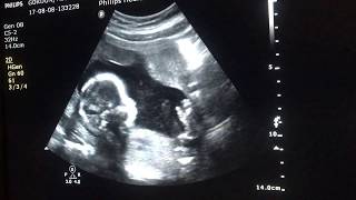 Ultrasound of baby movements at 19 weeks [upl. by Clayton]