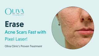 Erase Acne Scars Fast with Pixel Laser  Oliva Clinic’s Proven Treatment [upl. by Koerner]