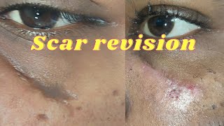 scar revision surgery Result scar revision surgery in Ranchi laser scar revision surgery [upl. by Tomlin]