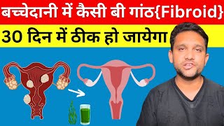 बच्चेदानी में गांठ या रसौली होने का कारण इलाज उपचार दवा  Fibroid ka ilaj in hindihomeopathic [upl. by Navnod]