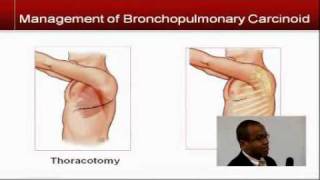 Surgical Management of Bronchial Carcinoids  Dr Robert Merritt [upl. by Brottman]