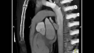 How to evaluate the aortic valve using cardiac CT imaging [upl. by Bar597]