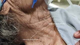 Arterial pulsation vs Venous pulsation Department of Medicine DMIHER [upl. by Schweiker541]