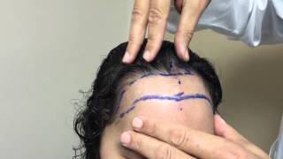 Plastic Surgeon Dr Jeffrey Epstein Solution For HighReceeding Hairline [upl. by Ybbed]