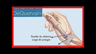 DeQuervains Tenosynovitis Behandlung [upl. by Richey]