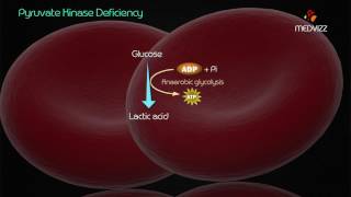 Pyruvate kinase deficiency [upl. by Bondie]